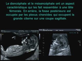 échographie  du cerveau au 1 er trim