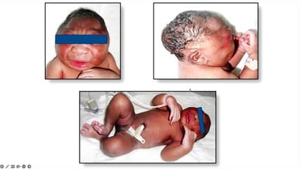 Actualités en infection (covid, autres virus et infections moins connues)