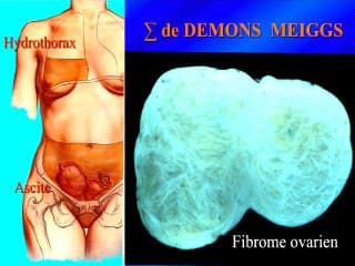 Imagerie des myomes:Apport de l’IRM