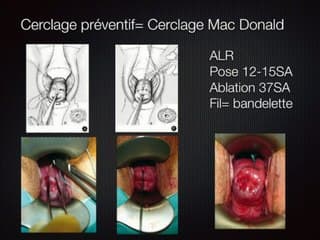 PATHOLOGIE DE LA CICATRICE : Cerclage : indications échographiques du cerclage et surveillance échographique des cerclages MacDonald et des cerclages définitifs
