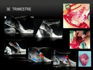 DIAGNOSTIC DU PLACENTA ACCRETA : EXPÉRIENCE D’UNE MATERNITÉ DE RÉFÉRENCE TUNISIENNE