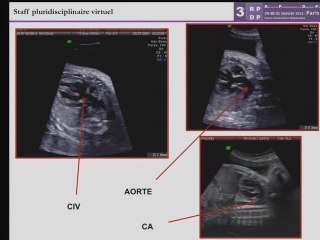 Cardiopathie conotroncale dans le cadre d'une délétion 22q11