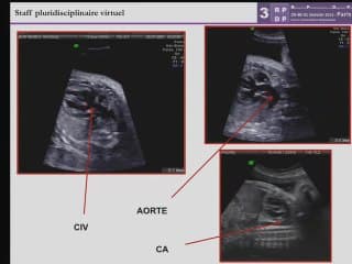 Cardiopathie conotroncale dans le cadre d'une délétion 22q11