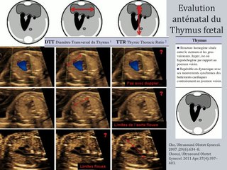 Evaluation du thymus fœtal dans la microdélétion 22q11.2 : lancement de l’étude prospective THYMI.