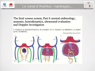 Agénésie du canal d'arantius et fistules hépatiques : la poule et l'oeuf