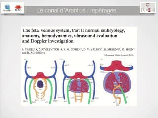 Agénésie du canal d'arantius et fistules hépatiques : la poule et l'oeuf