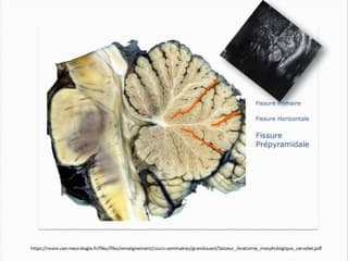 Le rhomboencéphalosynapsis : bon D…, mais c’est bien sûr (Une anomalie de la fosse cérébrale postérieure souvent méconnue en prénatal)