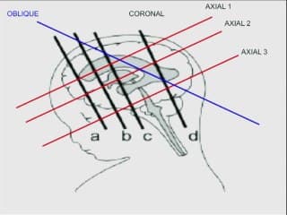 Un nouveau signe pour le dépistage du spina bifida au 1er trimestre de la grossesse