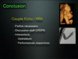 Comparaison de l’apport diagnostique de l’échographie et de l’IRM dans l’évaluation des foetus porteurs de fentes faciales