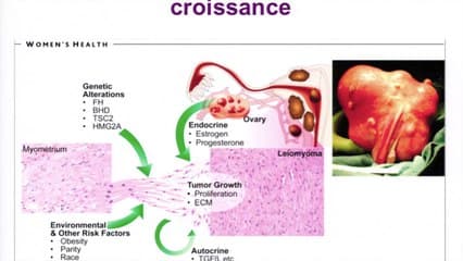 Fibromes : nouvelles stratégies Nouvelle molécule, nouvelle stratégie de traitement : place des SPRM