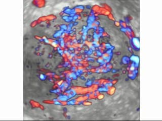Fibromes et acétate d’ulipristal (Esmya) : qu’attendre de l’échographie ?
