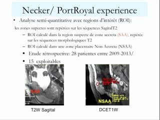 Apport de l'injection de gadolinium dans l'évaluation des placentas accreta