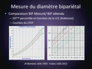 Contribution de l'étude du V4 au diagnostic du spina bifida au 1er trimestre. Etude du CFEF