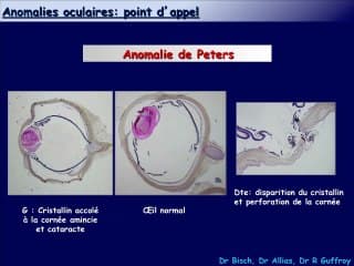 Bilan d'une anomalie de l'oeil en ante_natal