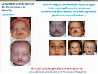 l'IRM des fentes labio palatines