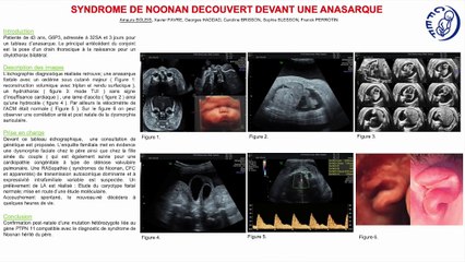 syndrome de noonan