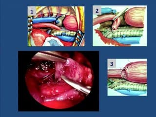 Atrésie de l'oesophage et thoracoscopie