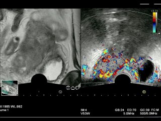 Échographie de fusion en gynécologie. Quelles sont les indications ? Y a-t-il une réelle aide au diagnostic ?