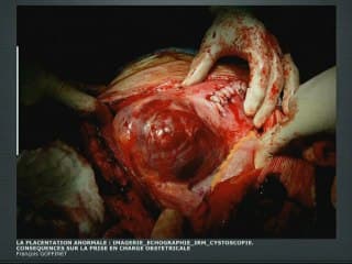 La placentation anormale : Imagerie - Echographie - IRM - Cystoscopie. Conséquences sur la prise en charge obstétricale