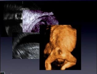 L’échographie du 1er trimestre peut-elle remplacer l’échographie du 2ème trimestre ?