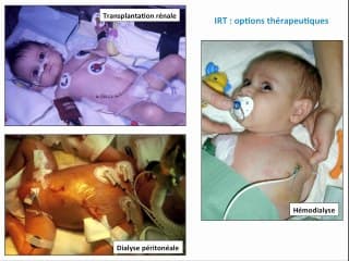 Valve de l'urètre postérieur  Pronostic néphrologique