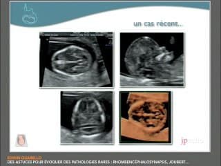 Des astuces pour évoquer des pathologies rares : rhombencéphalosynapsis , Joubert?