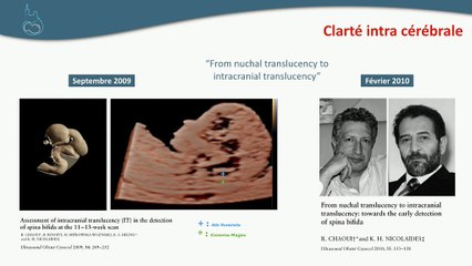 Qu’attendre de l’analyse systématique de la fosse postérieure au 1er trimestre ? Le spina bifida ouvert bien sûr, mais pas seulement.