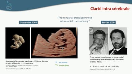 Qu’attendre de l’analyse systématique de la fosse postérieure au 1er trimestre ? Le spina bifida ouvert bien sûr, mais pas seulement.