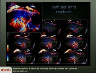Démonstrations 3D à partir de volumes et d’un examen sur patiente Coeu