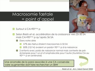 Syndrome de Beckwith Wiedeman-un diagnostic antenatal difficile : comparaison sur une série de14 cas, des signes échographiques anténataux et des constatations postnatales