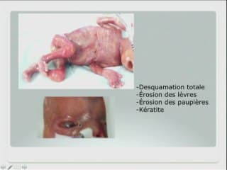 Floculation dans le liquide amniotique, étiologie infectieuse ?