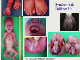 Les maladies génétiques a_ rechercher devant des troubles de la croissance