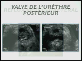Valve de l'urèthre postérieur :  l'imagerie foetale.