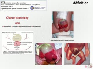 L'écartement des points pubiens, clé du diagnostic de l'extrophie vésicale ? (étude préliminaire)