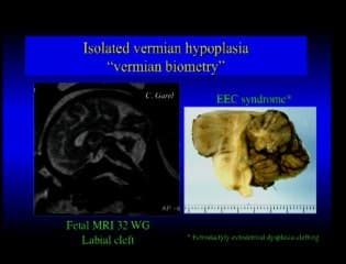 Dysgénésie vermienne et autres hypoplasies cérébelleuses