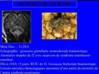 Cerveau foetal : apports spécifiques de l’IRM