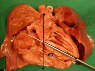 Les anomalies cono troncales rappel embryologique corrélations écho anatomiques