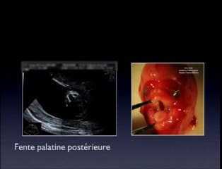 Apport des sondes haute fréquence au dépistage et au diagnostic des anomalies morphologiques du 1er trimestre