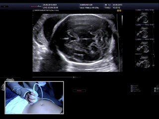 Live : étage sus-tentoriel : ligne médiane, ventricules et à 22sa