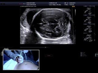 Live : étage sus-tentoriel : ligne médiane, ventricules et à 22sa