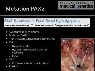 Hypo dysplasie renale