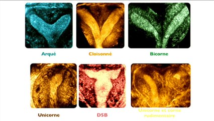Les classifications échographiques ? Fibrome ? Kyste? Malformations utérines