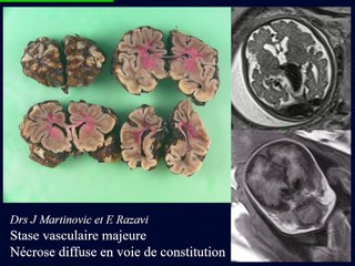 Les malformations vasculaires intracrâniennes