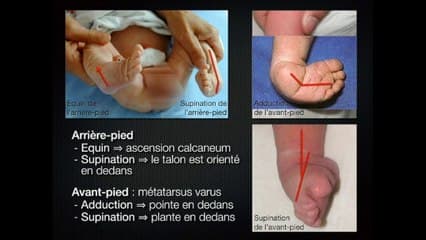 Les anomalies de posture de pieds : ce n’est pas si simple.