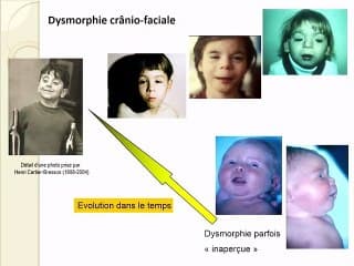 Imagerie de l’alcoolisme foetal