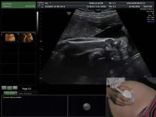 L'échographie de dépistage « revisitée ». Les coupes « obligatoires » et les coupes souhaitables. Les trucs et astuces pour y arriver. démonstrations « Live ».