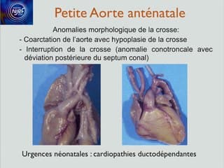 Coeur foetal I : c’est trop petit ! Petite aorte et pathologies de crosse