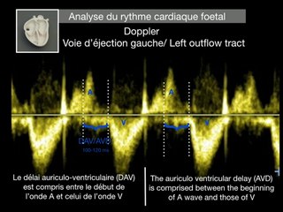 CŒUR ET VAISSEAUX Troubles du rythme dits “simples”