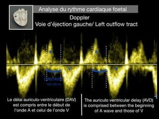 CŒUR ET VAISSEAUX Troubles du rythme dits “simples”