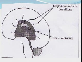 Et si on vous montrait la suite ? Agénésie du corps calleux